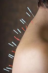 What is Accupuncture?