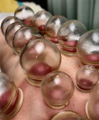 What is Cupping Therapy